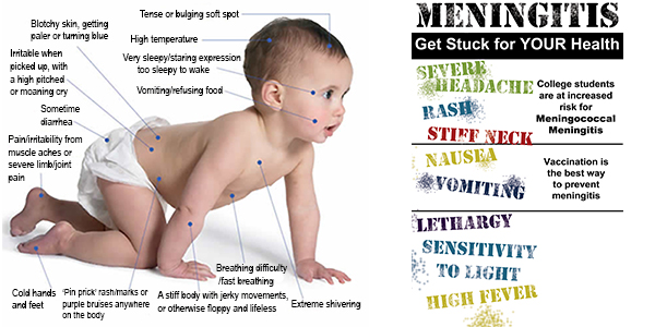 Meningitis baby